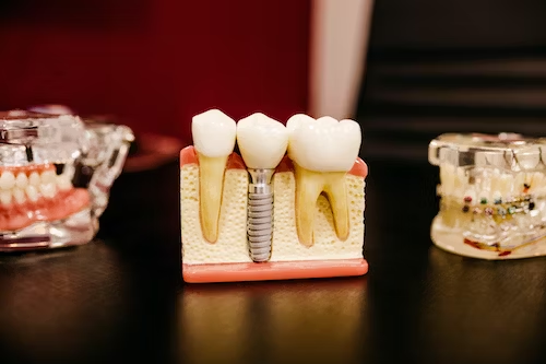 dental implant on a dental model between two healthy teeth