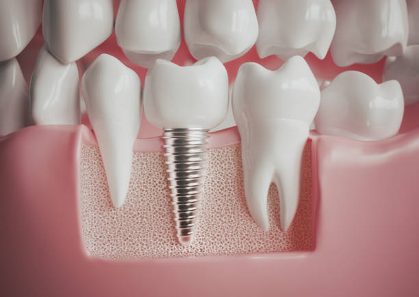 a digital illustration of a dental implant among healthy teeth