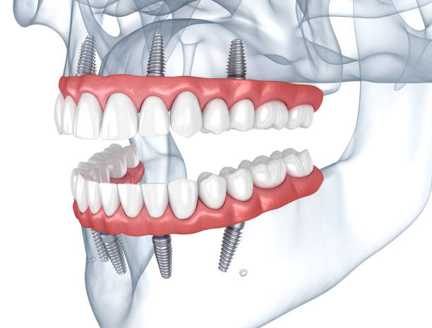 What Do Dental Implants Look Like?