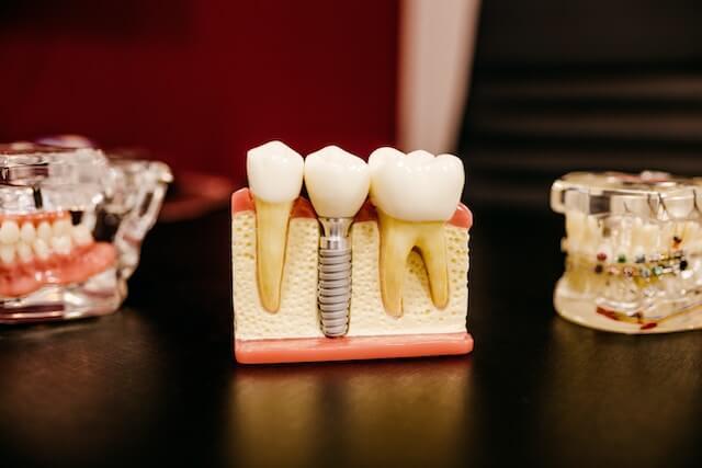 a model of dental implant between two teeth