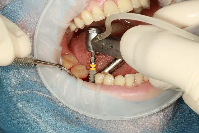 installing dental implant close-up shot