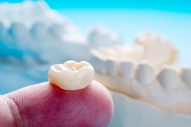 a close-up view of a dental crown